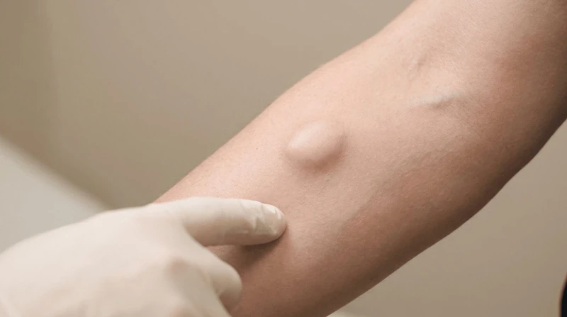 Doctor examining a soft-tissue lump on a patient's forearm