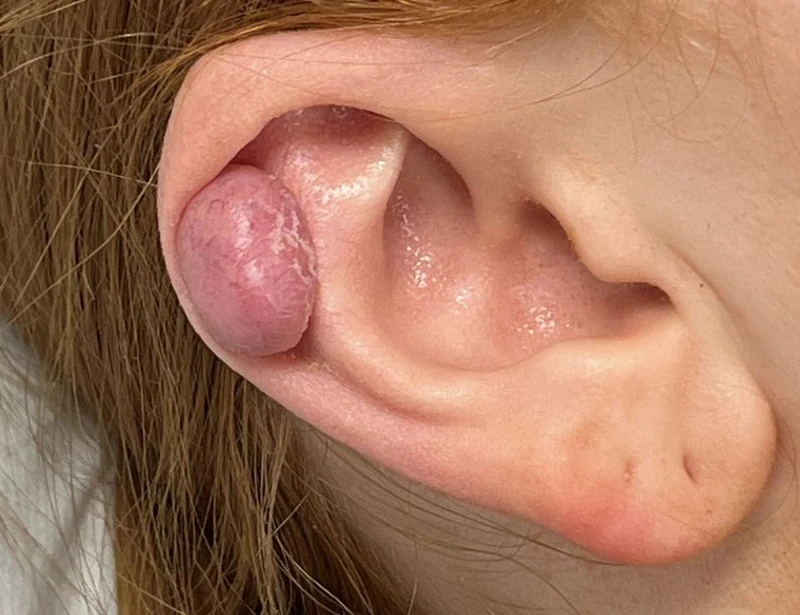 Ear with a raised skin lesion on the rim