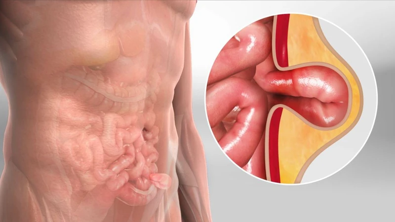 Hernia illustration