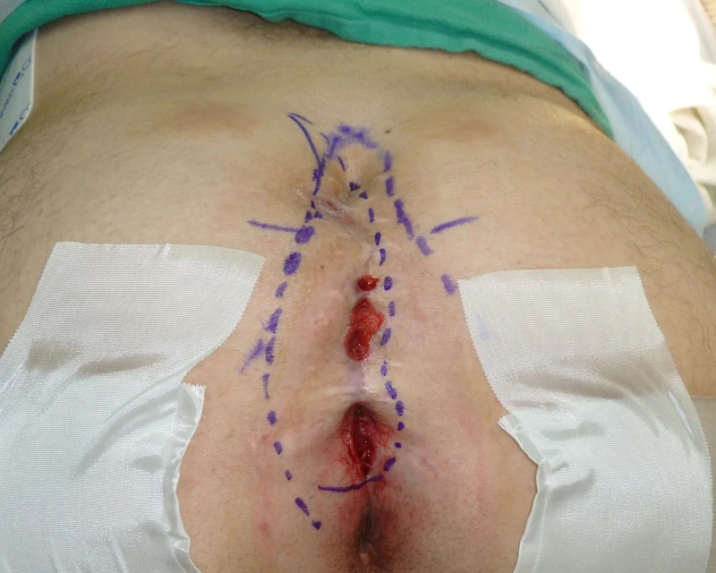 Pilonidal sinus marked before surgery