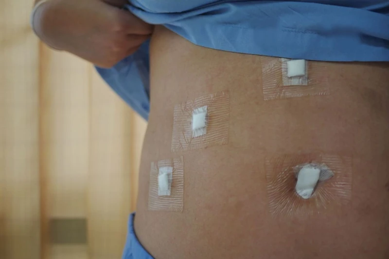 Small keyhole dressings after laparoscopic gallbladder surgery