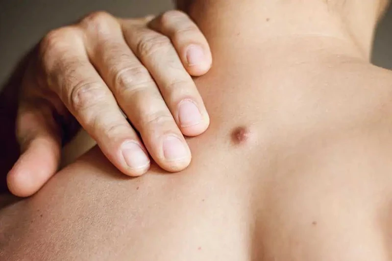 Small skin lump on the upper back near the shoulder