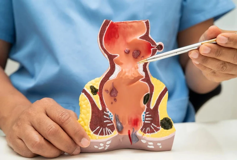 Surgeon explaining piles, fissure and fistula on an anorectal model