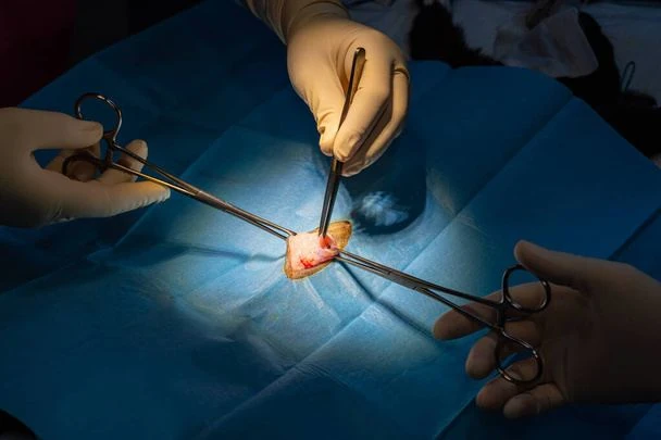 Surgeons performing appendix surgery